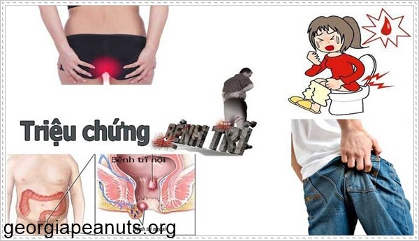 C&aacute;c dấu hiệu triệu chứng của bệnh trĩ