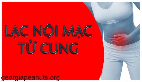 Lạc nội mạc tử cung gây nên bệnh hiếm muộn