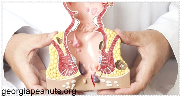 Dấu hiệu của bệnh trĩ ngoại