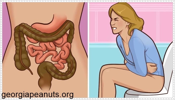 Bệnh trĩ ngoại g&acirc;y đại tiện ra m&aacute;u