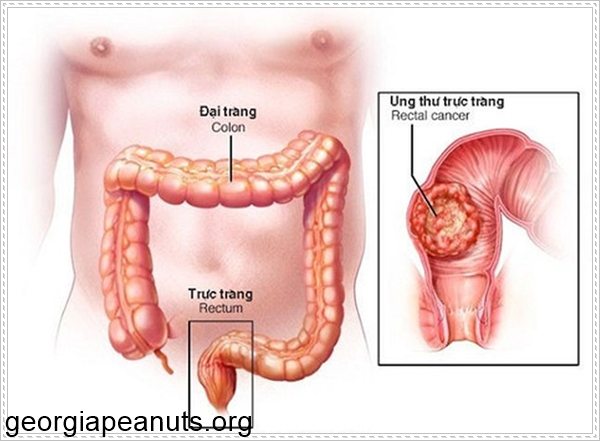 Đại tiện ra m&aacute;u do vấn đề về đại tr&agrave;ng v&agrave; trực tr&agrave;ng