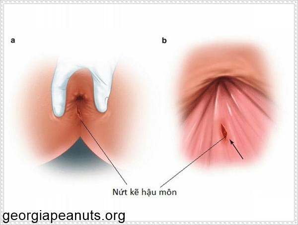 Bị nứt kẽ hậu m&ocirc;n dẫn đến đau r&aacute;t