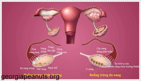 Dị tật buồng trứng bẩm sinh