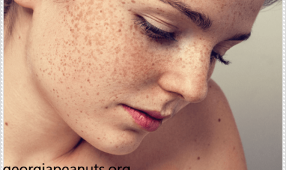 Điều trị nám da với thảo dược nấm lim xanh