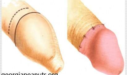  Phẫu thuật cắt bao quy đầu tại tphcm