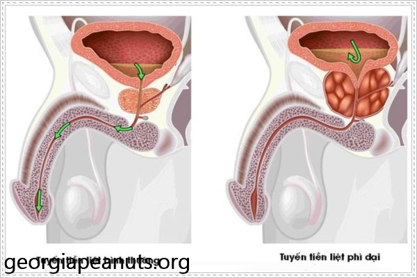 Bệnh tuyến tiền liệt thường xảy ra ở nam giới