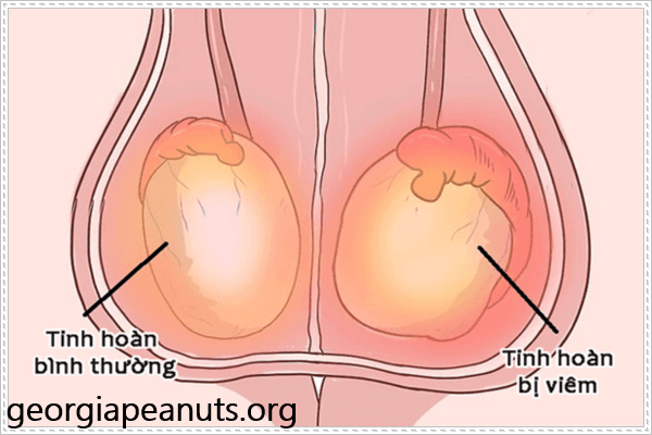 Đầu dương vật ra m&aacute;u do vi&ecirc;m t&uacute;i tinh