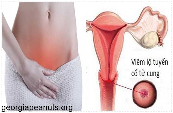 Kh&iacute; hư v&oacute;n cục do vi&ecirc;m lộ tuyến cổ tử cung