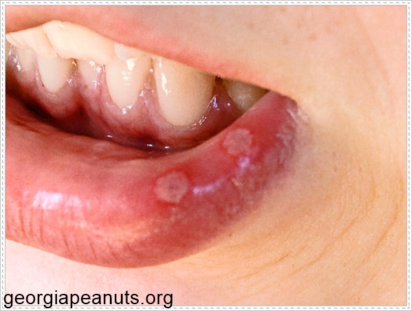 Triệu chứng của nhiễm HPV khi quan hệ bằng mồm