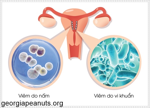 Bệnh vi&ecirc;m lộ tuyến cổ tử cung